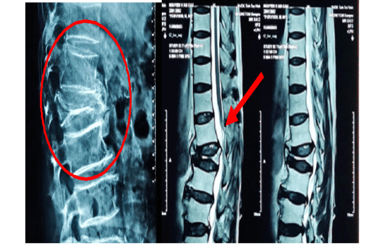 CHẤN THƯƠNG CỘT SỐNG TÁC HẠI CỦA VIỆC ĐIỀU TRỊ KHÔNG ĐÚNG CÁCH