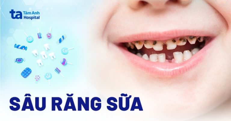 Răng sữa bị sâu: Nguyên nhân, dấu hiệu và cách phòng ngừa