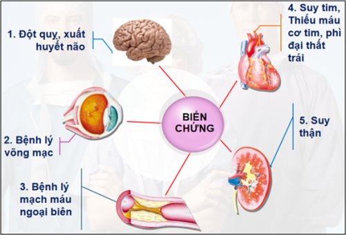 Hưởng ứng Ngày thế giới phòng chống tăng huyết áp 17/5/2022 với ...