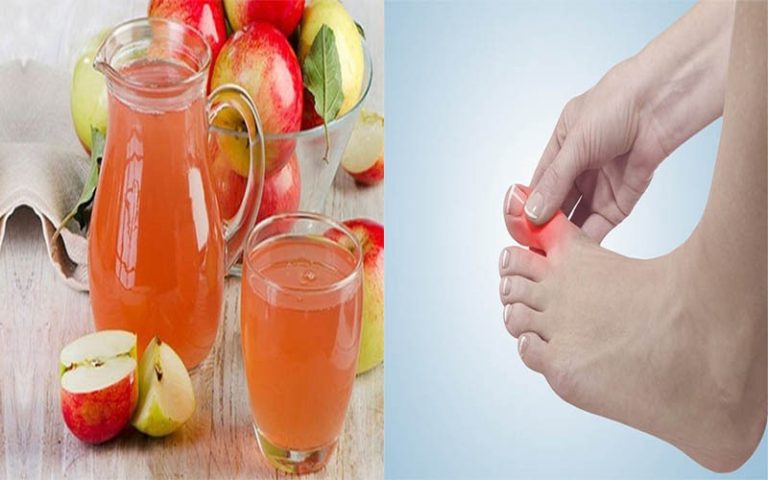 6 loại đồ uống làm giảm axit uric máu ngăn ngừa bệnh gout hiệu quả