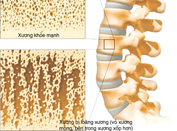 Cách bổ sung canxi cho người lớn tuổi đúng cách - ALOSUCKHOE