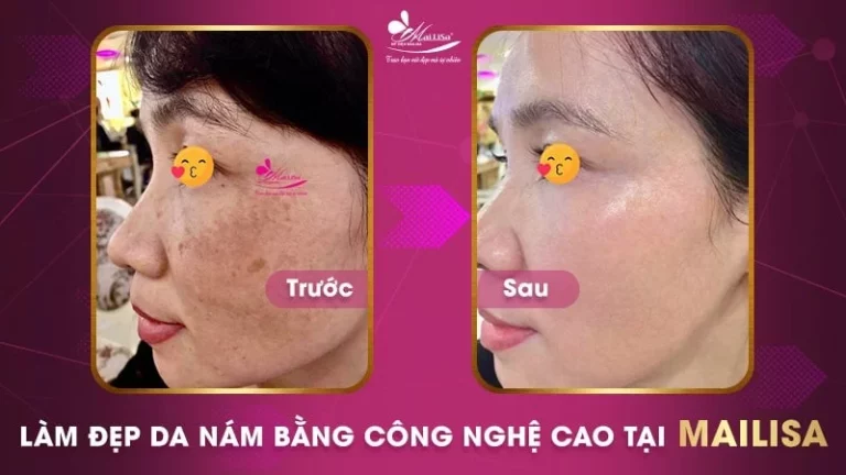 Cách Trị Vết Thâm Sau Khi Bắn Laser Hiệu Quả Nhất 2024