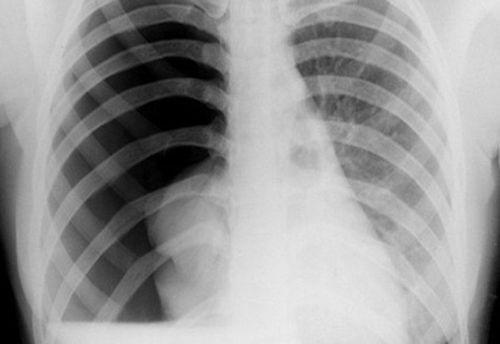 X-ray picture of pneumothorax | Vinmec