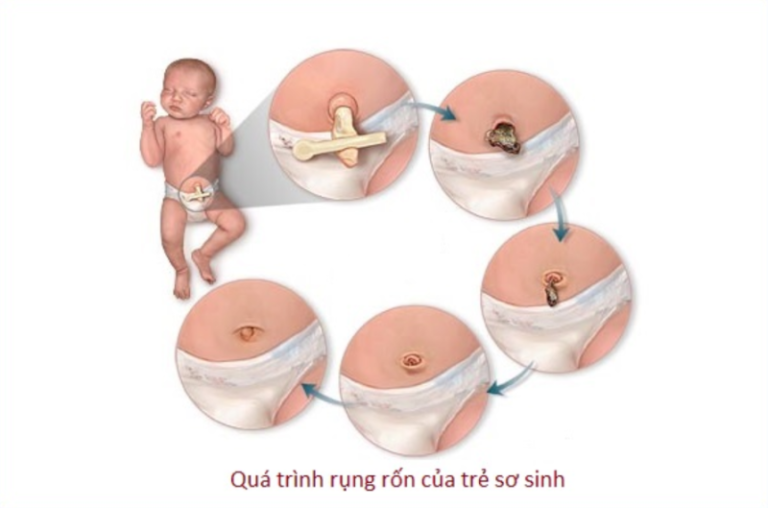 Dấu hiệu bé sắp rụng rốn và cách chăm sóc vệ sinh rốn hợp lý ...