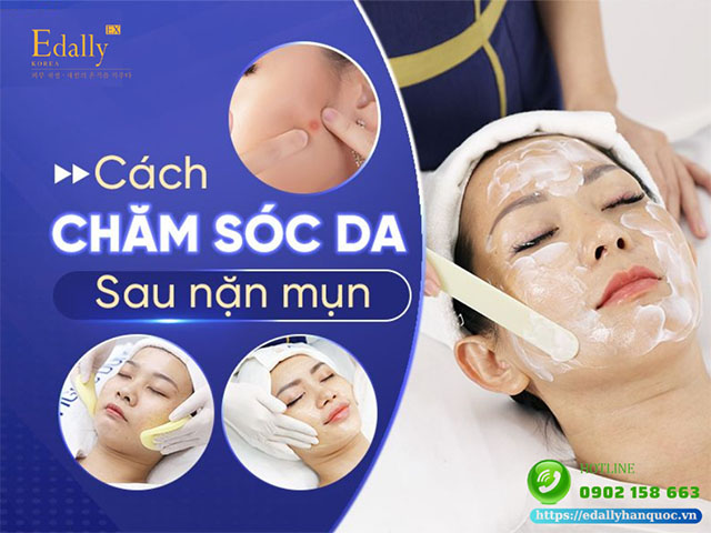 Cách Chăm Sóc Da Sau Nặn Mụn Sao Cho Nhanh Lành Và Không Để Lại Sẹo?