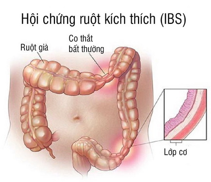 Liệu pháp tâm lý giúp kiểm soát hội chứng ruột kích thích