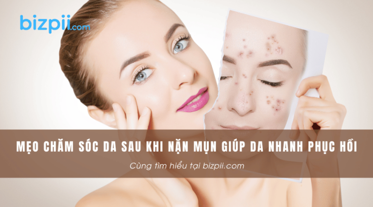 Mẹo chăm sóc da sau khi nặn mụn giúp da nhanh phục hồi