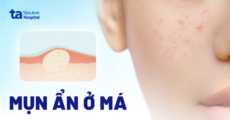 Mụn ẩn ở má: Nguyên nhân, dấu hiệu và cách phòng ngừa [A-Z]