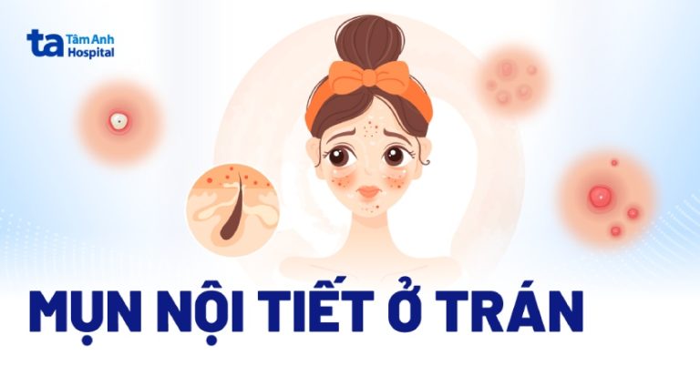 Mụn nội tiết ở trán: Nguyên nhân, triệu chứng và cách điều trị