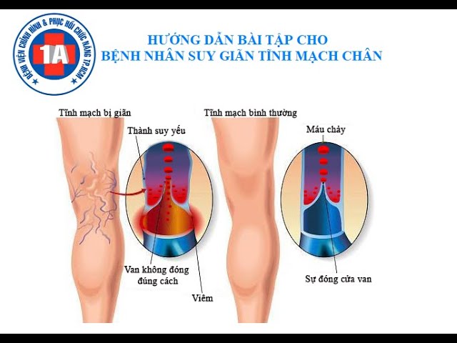 Hướng dẫn bài tập cho bệnh nhân suy giãn tĩnh mạch chân | BV1A ...