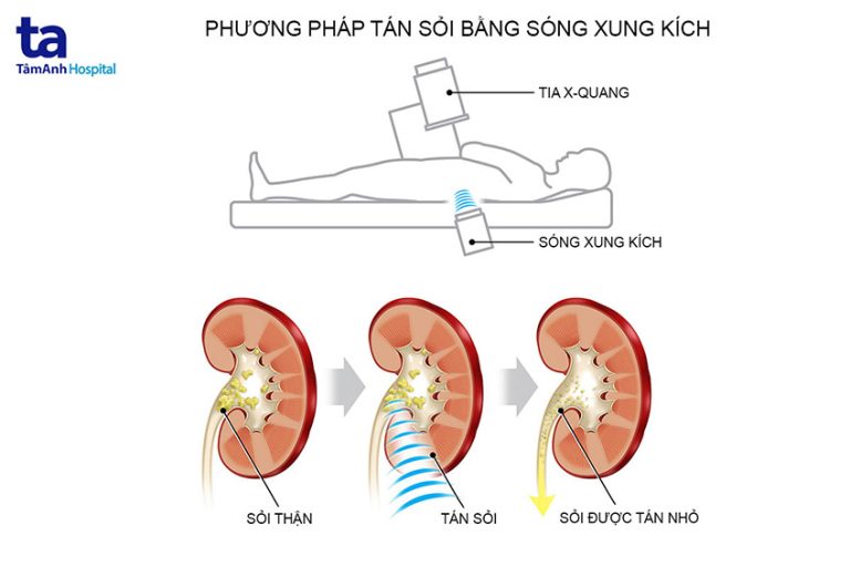 6 phương pháp điều trị sỏi thận tiên tiến hiện nay | Tâm Anh